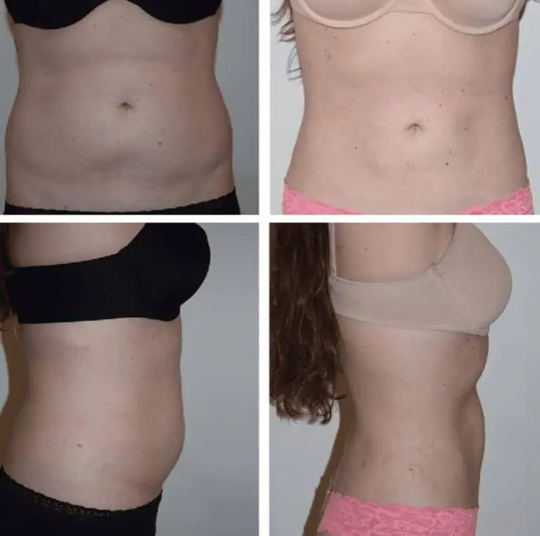 Stomach tuck before and after.