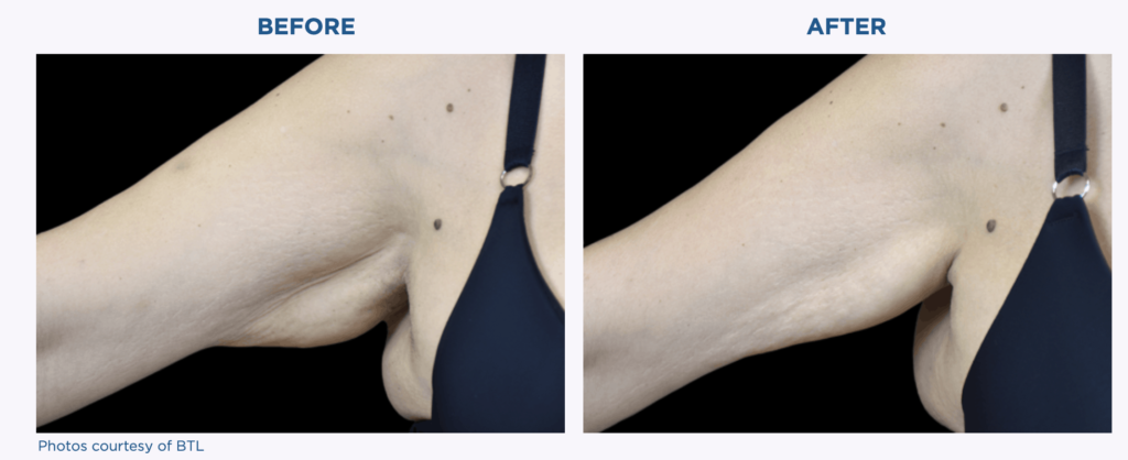 Before and after pictures showcasing the transformative effects of Emtone on a woman's arm.
