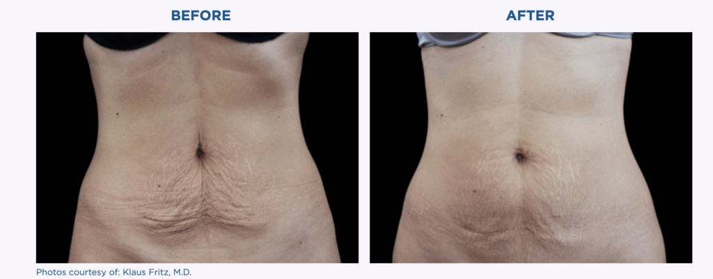Emtone tummy tuck before and after.