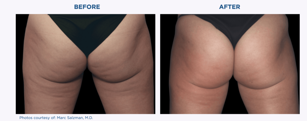 Before and after pictures showcasing the transformative results of Emtone on a woman's butt.