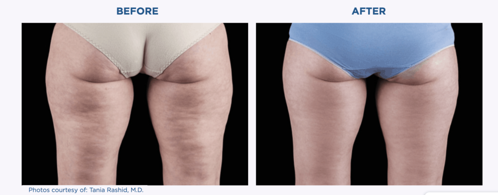 Before and after pictures showcasing the transformative effects of Emtone on a woman's legs.