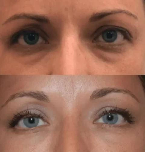 Before and after pictures showcasing the transformative effects of eyelid surgery on a woman's appearance.