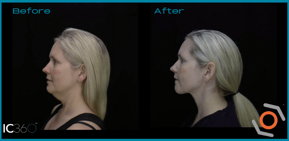 A woman's face before and after MyEllevate® liposuction.
