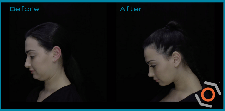 Before and after photos of a woman's MyEllevate® ear lobe surgery.