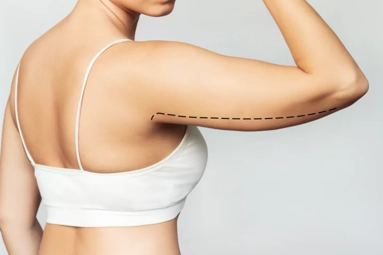 A woman undergoing arm liposuction.