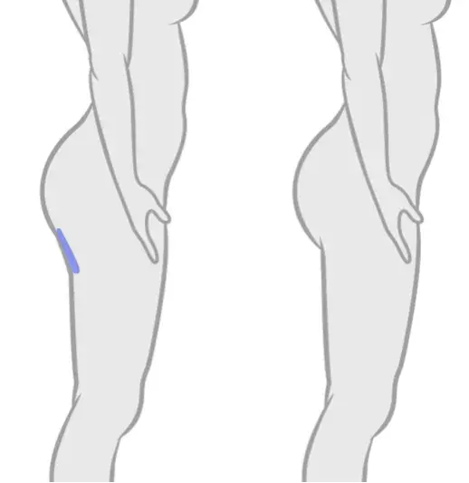 A woman's thigh is shown before and after a thigh lift, highlighting the significant improvement in contour and firmness.