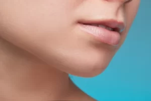 A close up of a woman's face with an exceptionally defined chin after undergoing chin Liposuction.