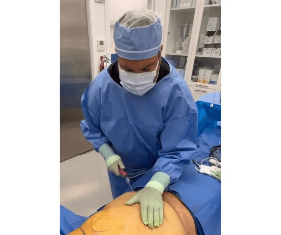 A surgeon is performing Lipo 360 surgery on a patient.