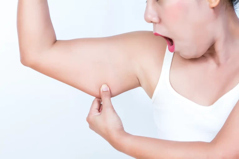 A woman displaying her arm after brachioplasty procedure.