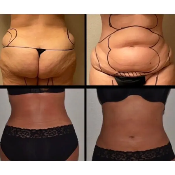 Stomach tuck before and after.