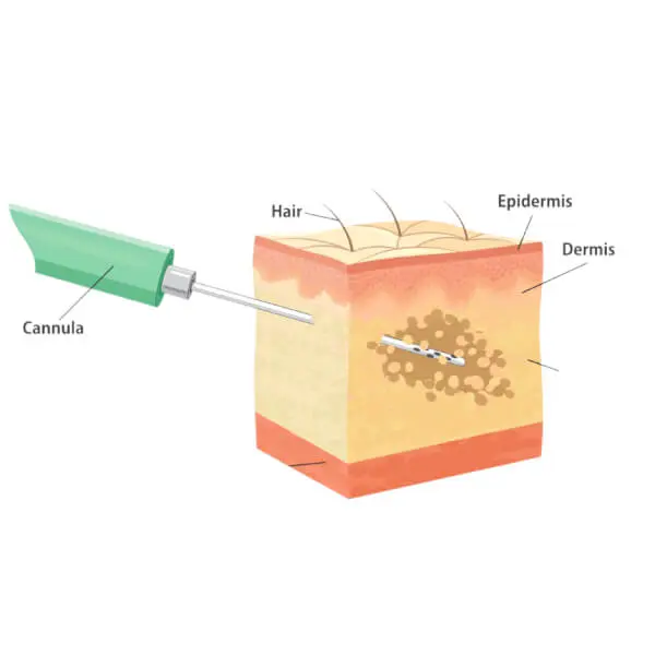A diagram of a skin with a VASER.
