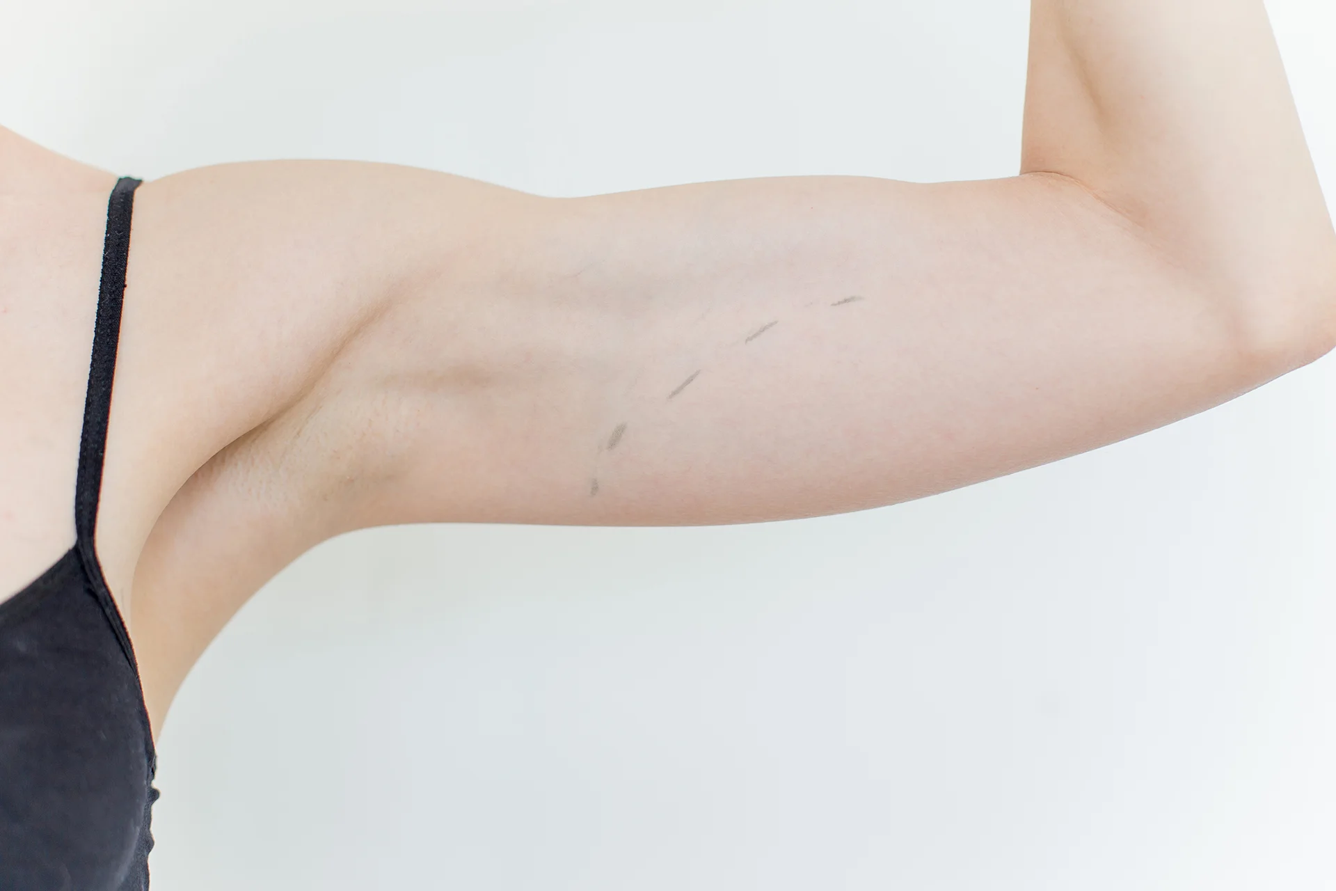 A woman's arm after lipo with j-plasma