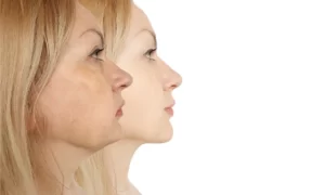 chin liposuction result