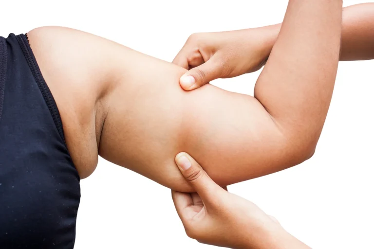 A person displaying arm after brachioplasty procedure.