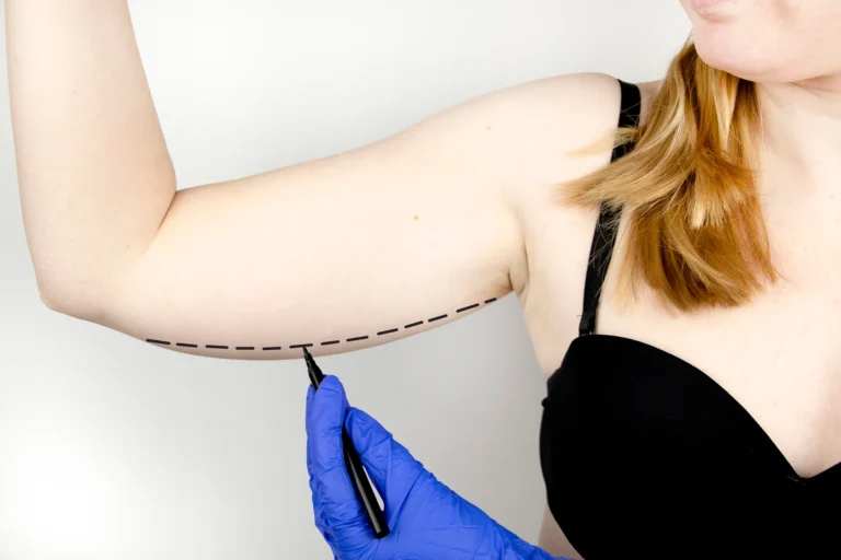 A person marking a dashed line on another person's upper arm with a marker, preparing for brachioplasty.