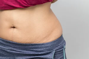 Close-up of a woman's midsection showing belly fat, wearing a magenta top and blue workout pants with a drawstring, ideal candidate for Mommy Makeovers.