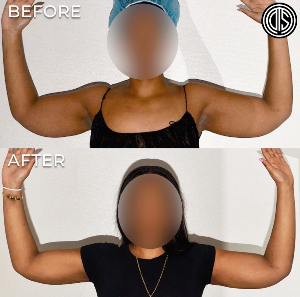 A woman raises her arms in two side-by-side photos labeled “Before” and “After,” showing a visible reduction in arm size. Her face is blurred in both images.