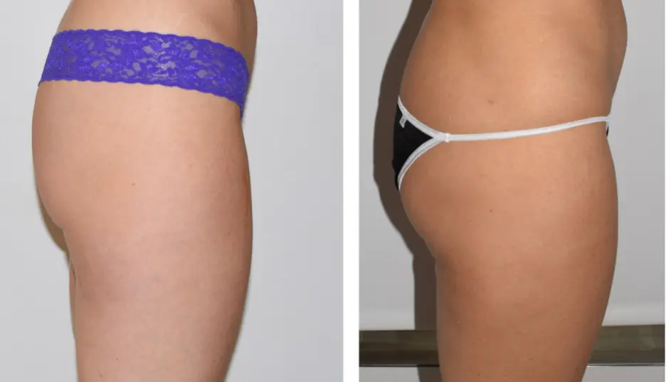 Side-by-side comparison of a person's upper thigh and buttocks in underwear, highlighting changes in body contour and the appearance of banana rolls between the two images.