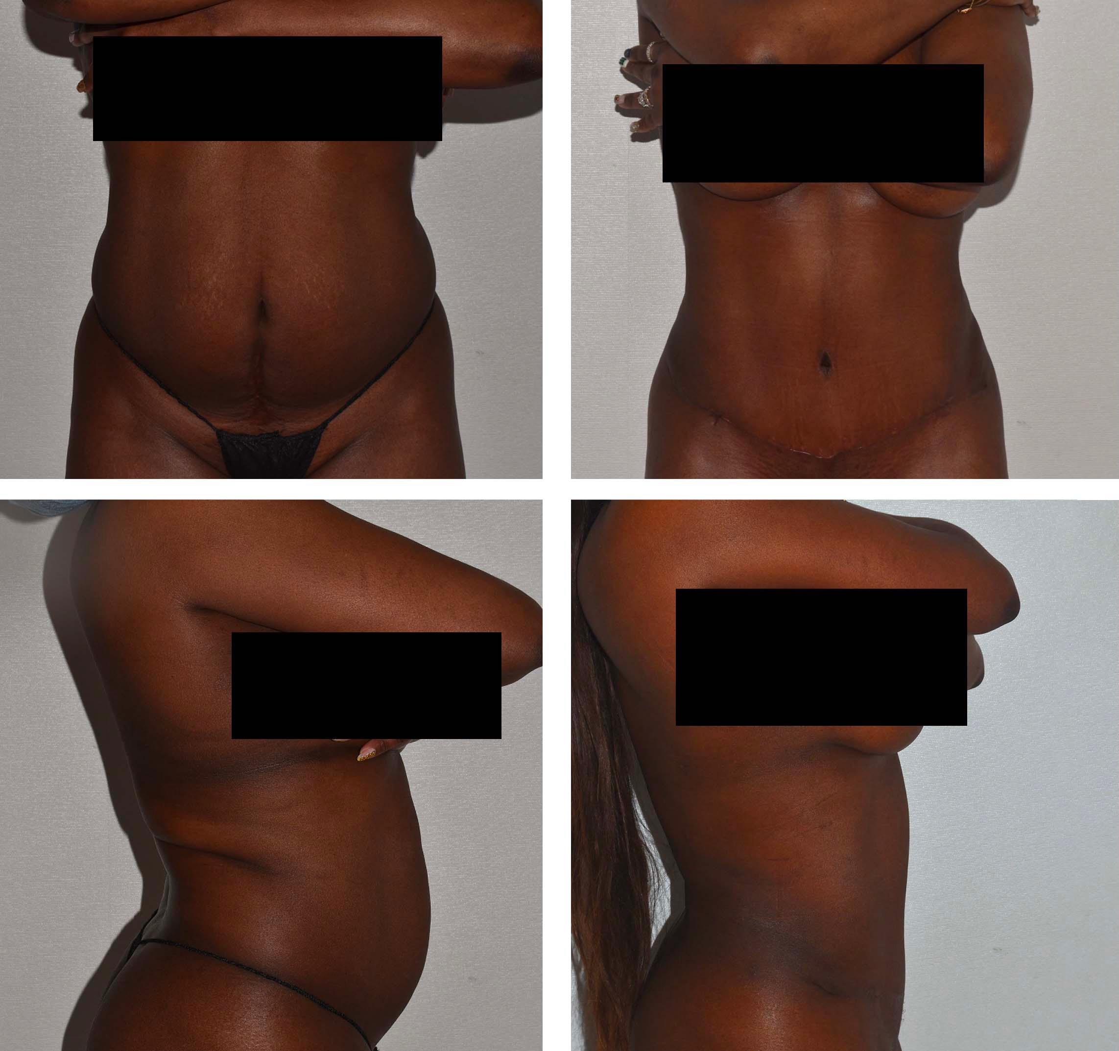 Four-panel image showing before and after side and front views of a woman’s torso, highlighting changes in abdominal contour and breast appearance. Eyes and chest are blacked out for privacy.