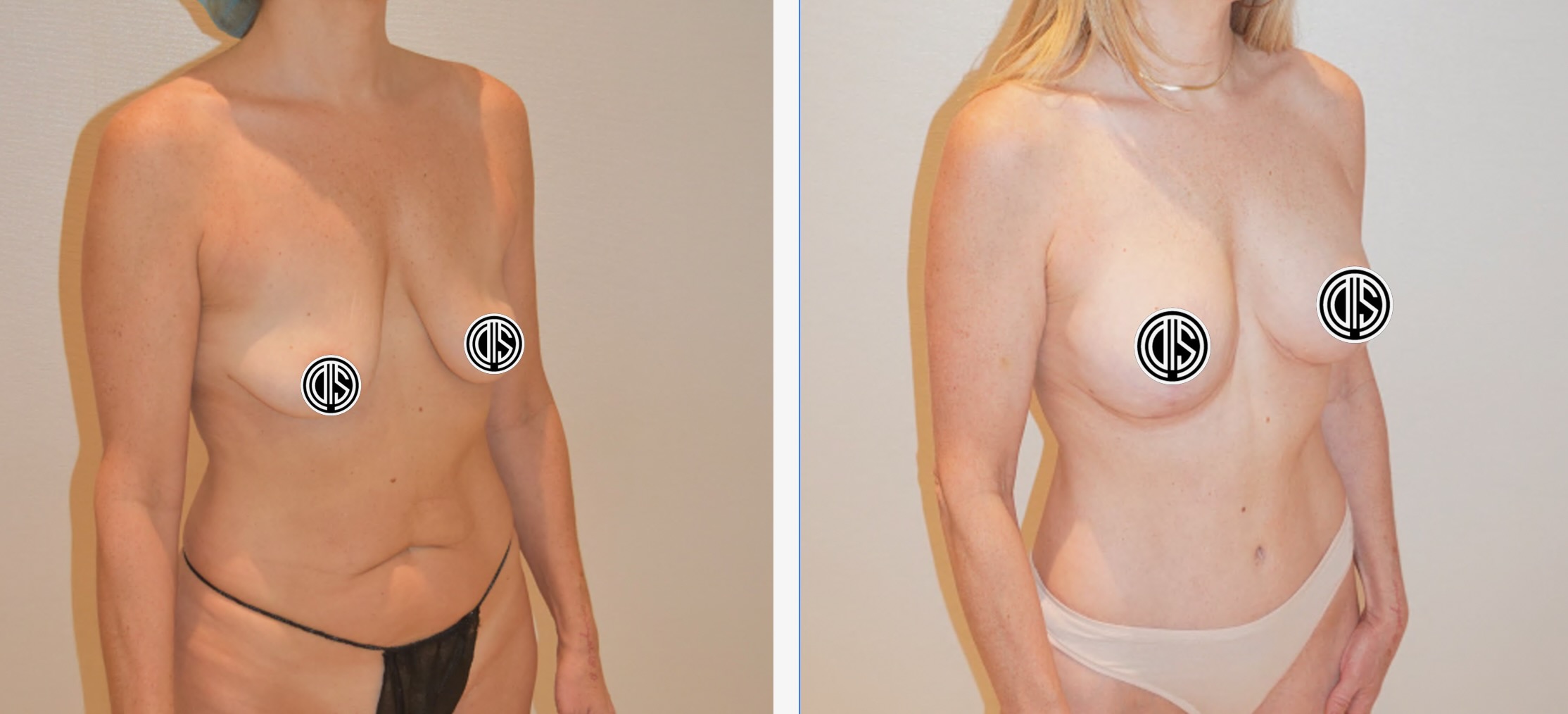 Side-by-side comparison of a woman’s torso before and after breast and abdominal cosmetic surgery, with areas of nudity covered by digital symbols.