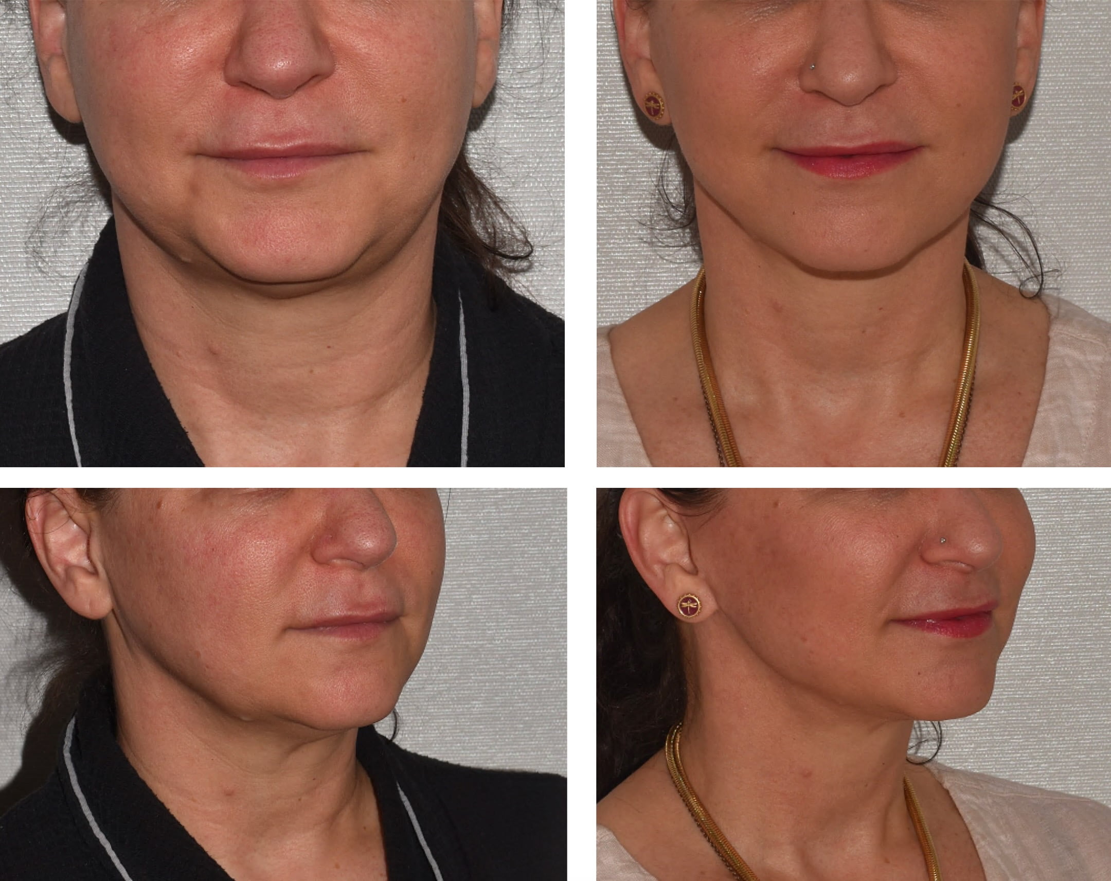 Four side-by-side photos showing a woman's lower face and neck before and after a cosmetic procedure, highlighting changes in skin texture and jawline contours.
