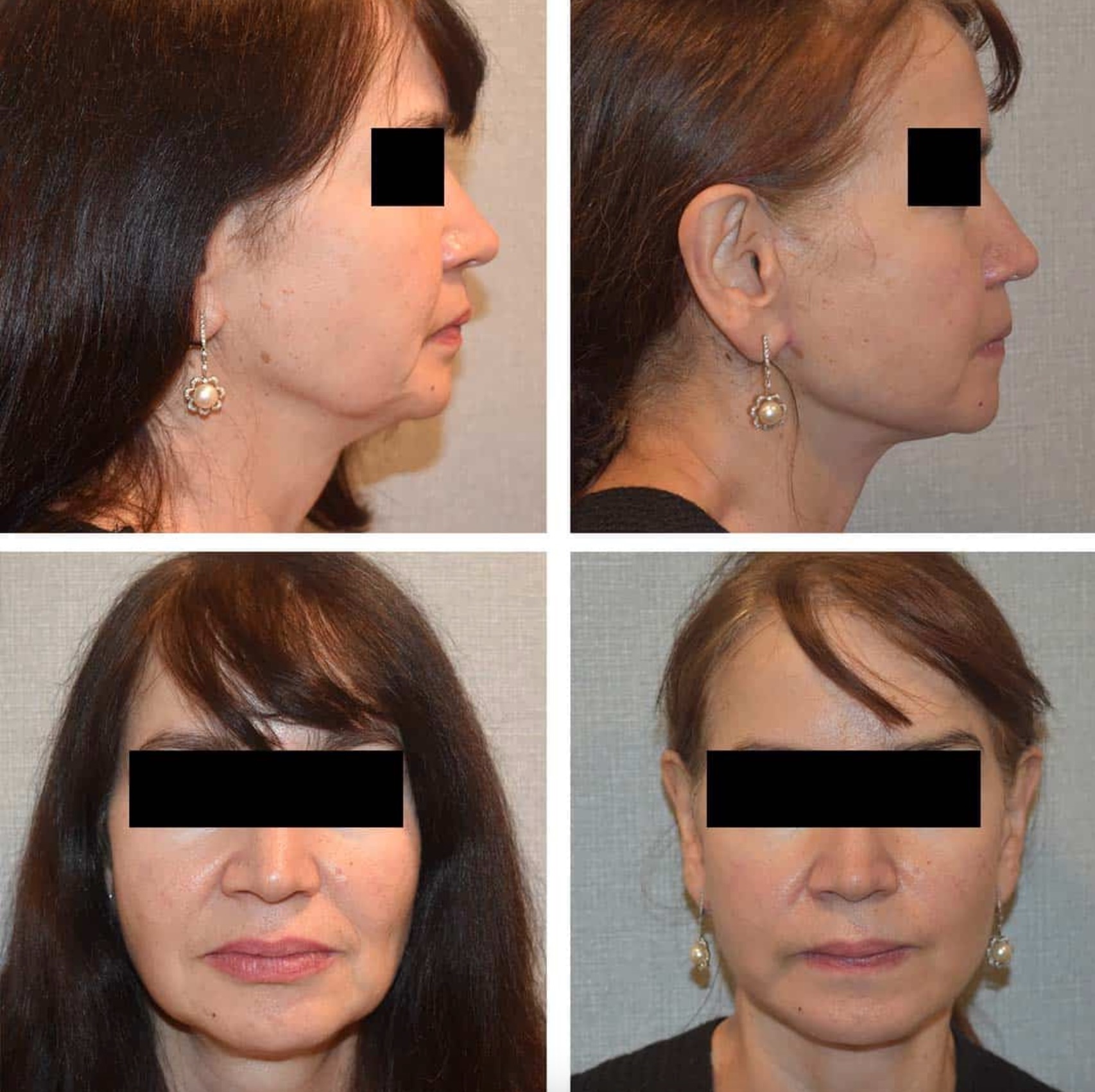 Side-by-side before and after photos of a woman’s face, showing changes in jawline and cheek area; eyes are blacked out for privacy.