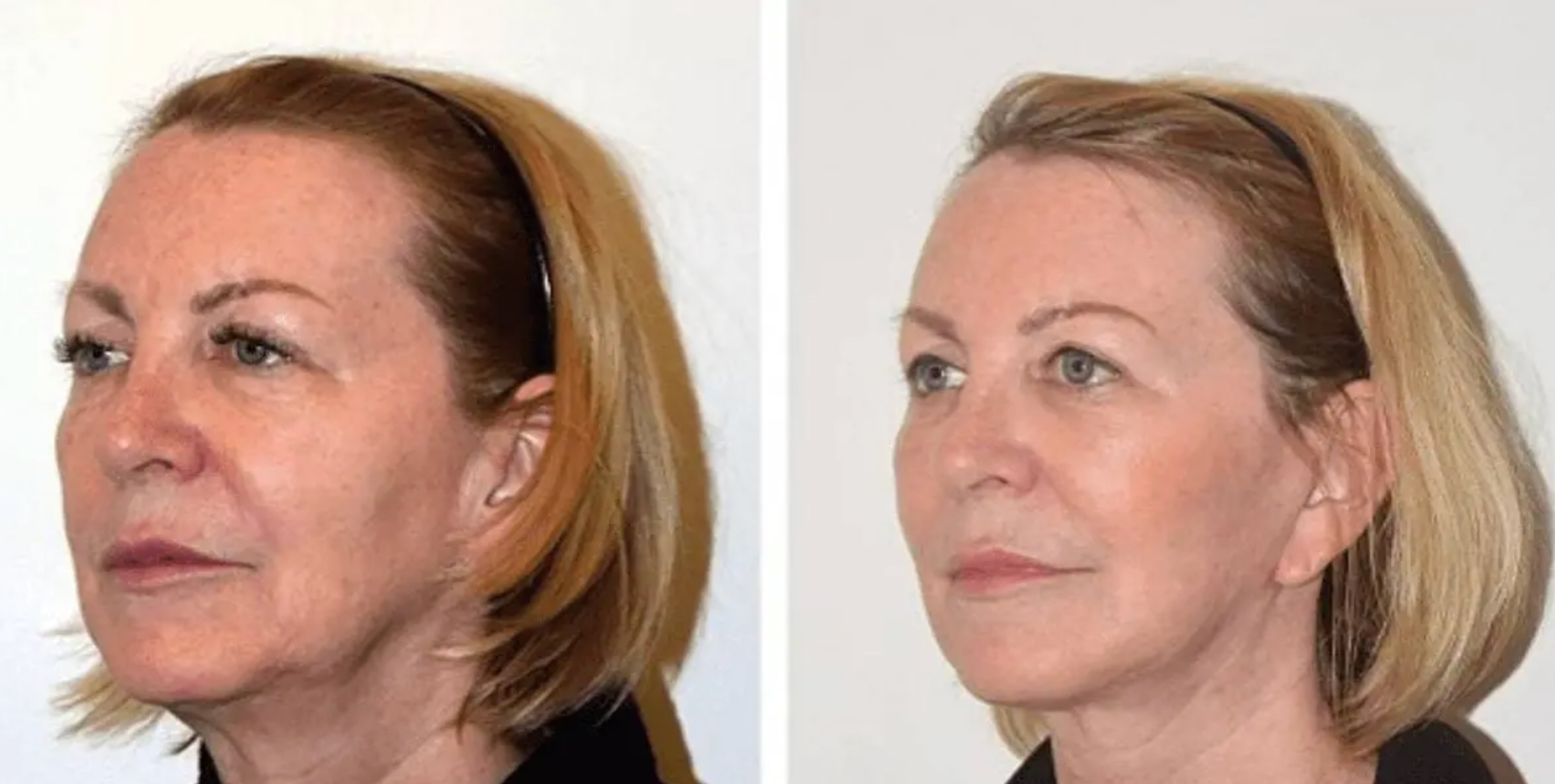 Side-by-side photos of a woman before and after a cosmetic procedure, showing smoother skin and lifted facial features in the after image.