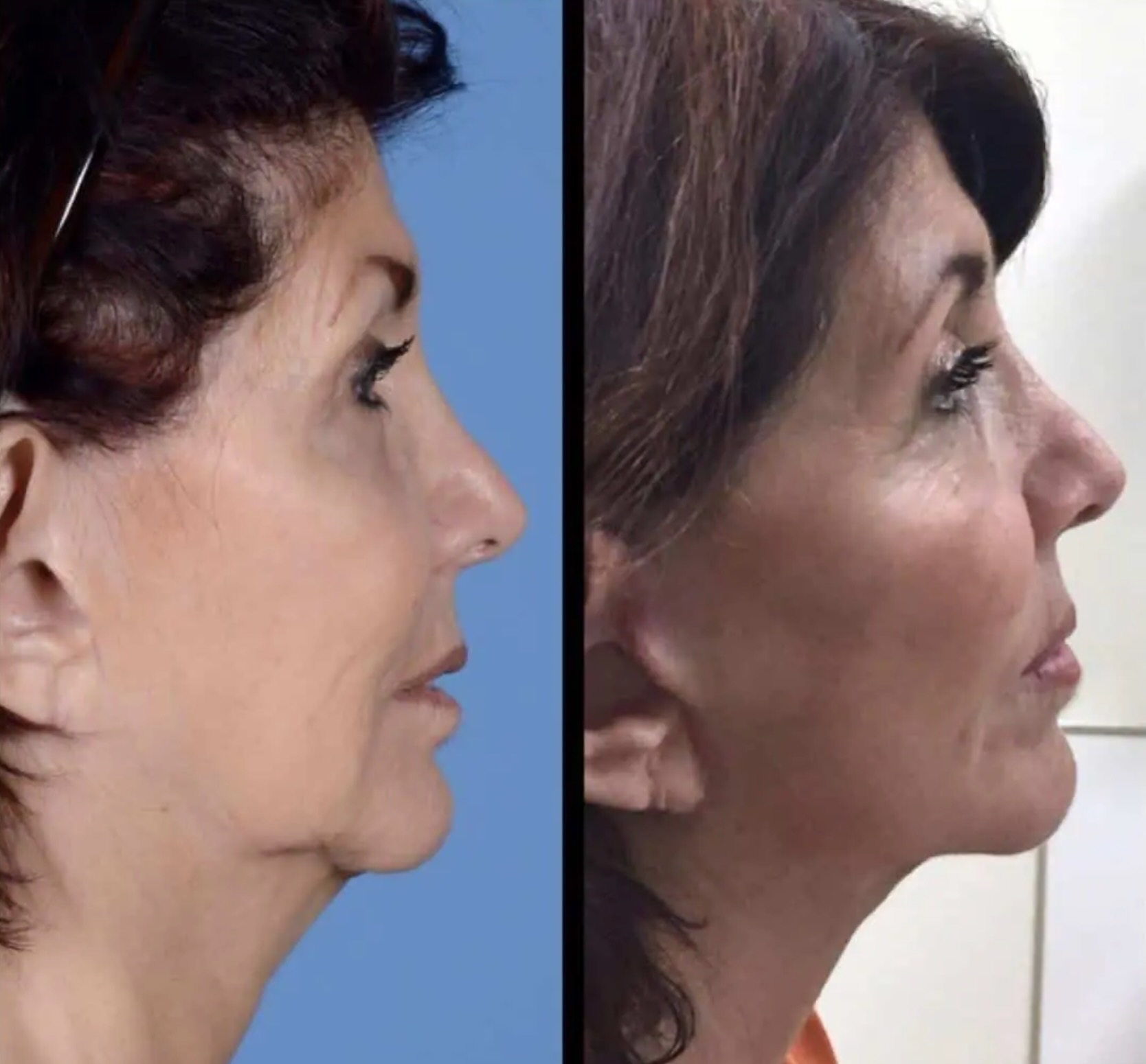 Side-by-side profile photos of a middle-aged woman before and after a cosmetic procedure, showing reduced sagging skin and a more defined jawline in the after image.