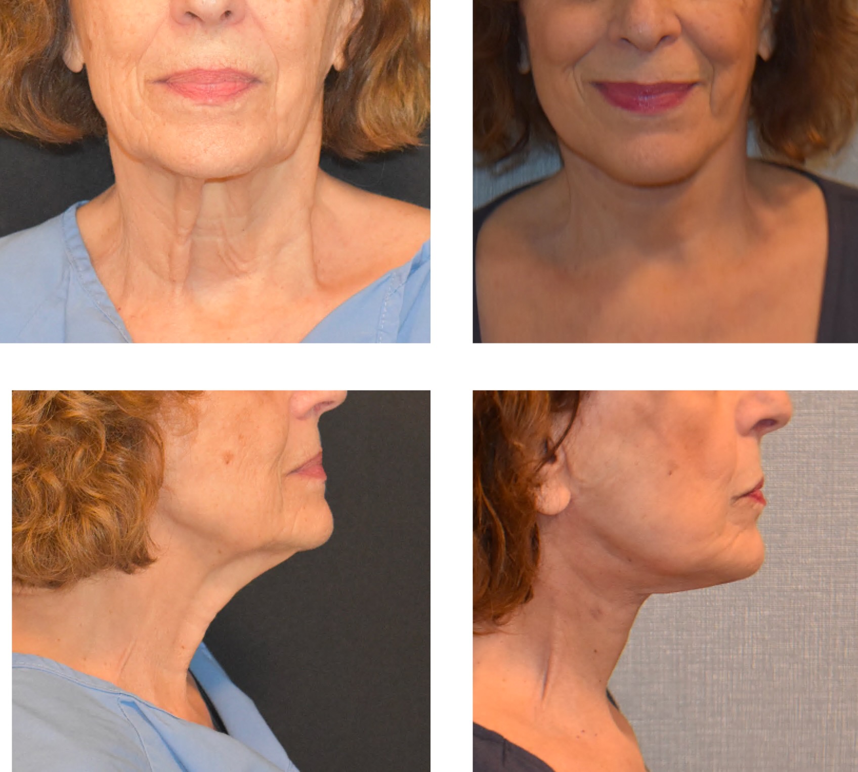Four before-and-after photos showing a woman's lower face and neck from front and side views, highlighting changes in skin tightness and jawline definition.