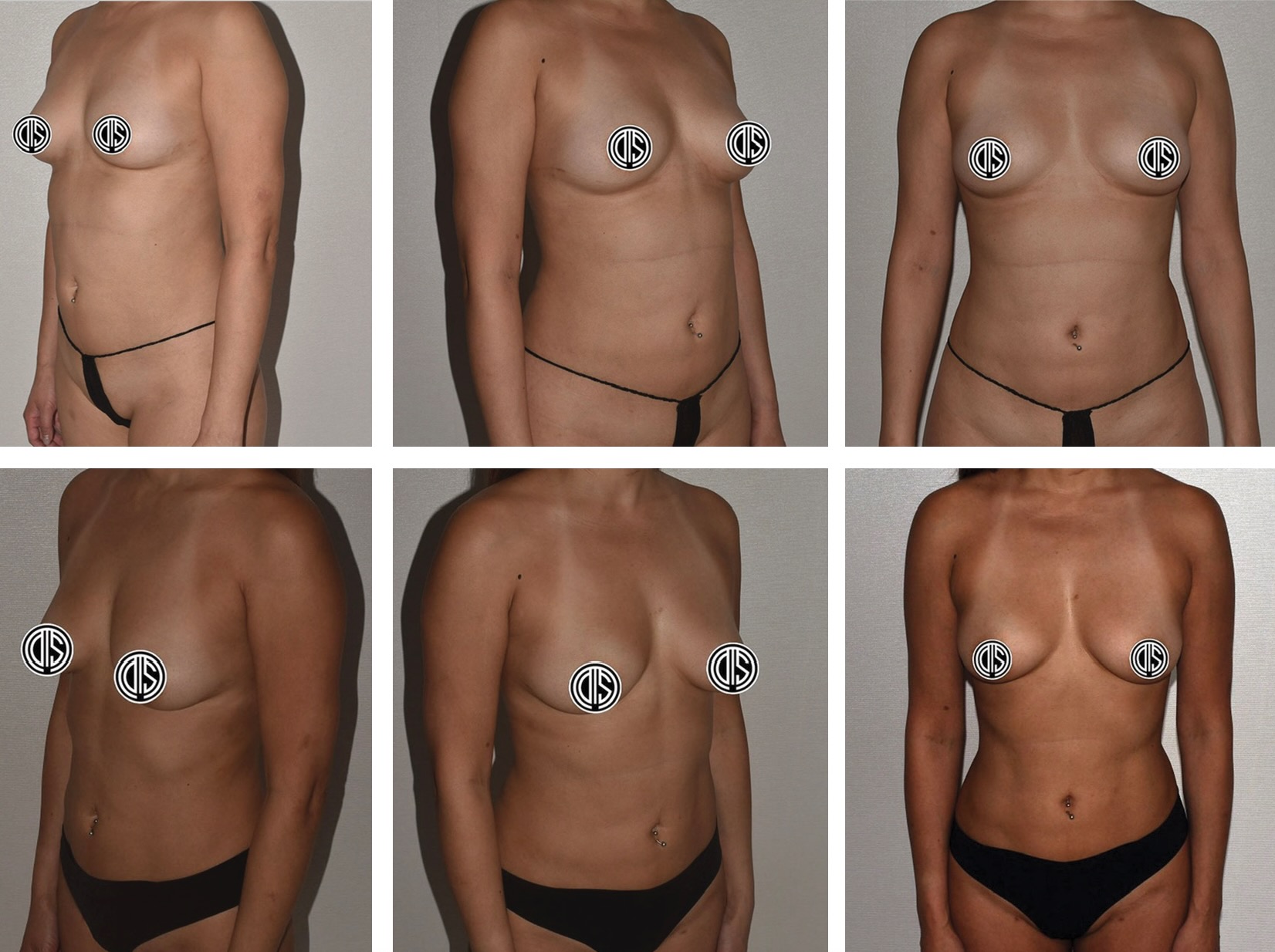 Six side-by-side photos showing a woman’s torso from different angles before and after breast surgery, with nipples censored for privacy.