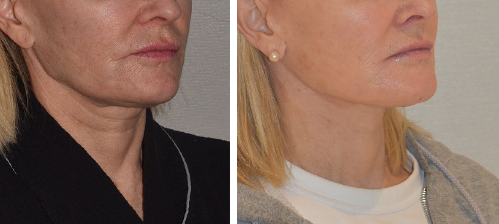 Side-by-side comparison of a woman's lower face and neck before (left) and after (right) a cosmetic procedure, showing smoother skin and reduced wrinkles.