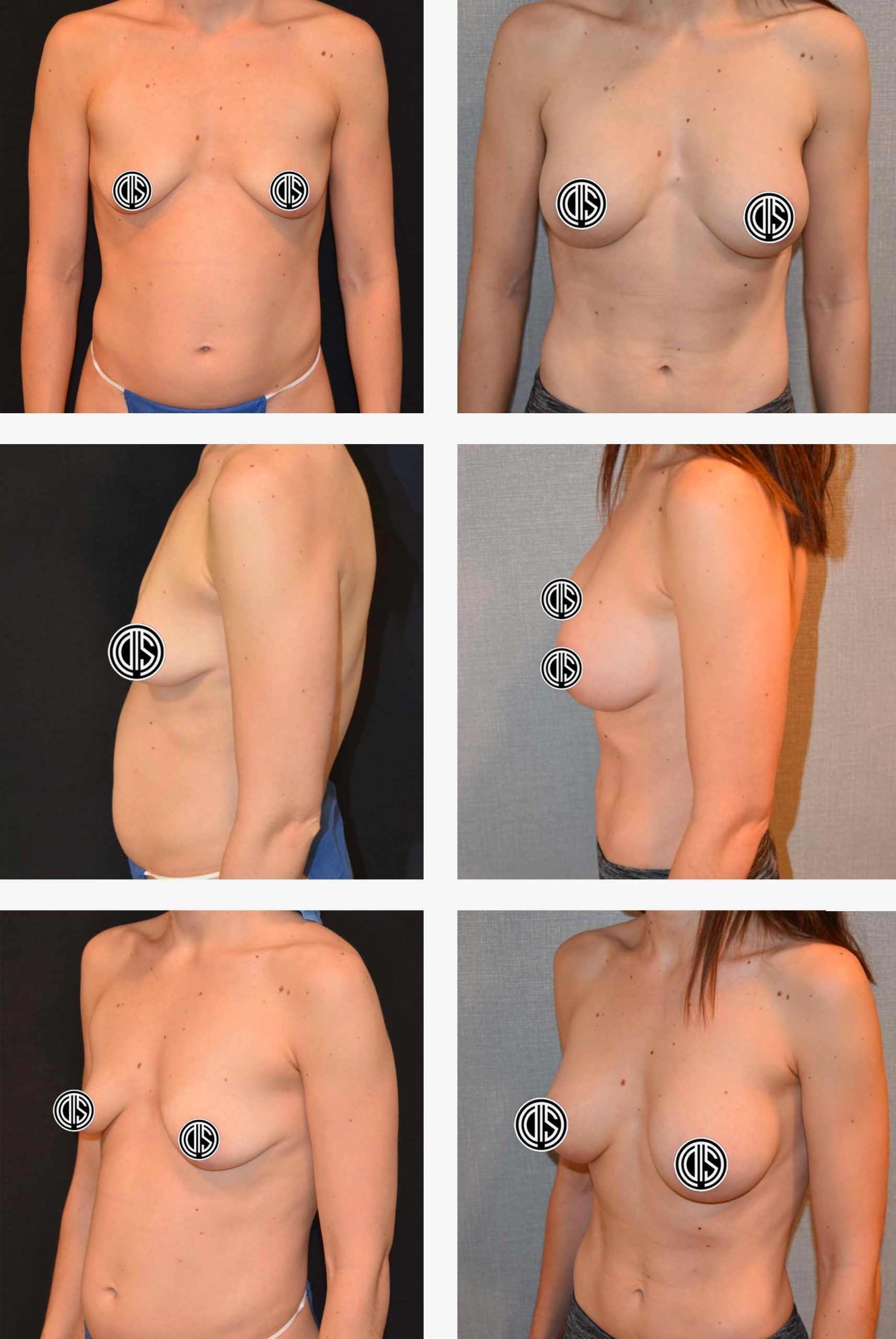 Before and after photos showing a woman’s torso from front and side views, illustrating physical changes following breast augmentation surgery.