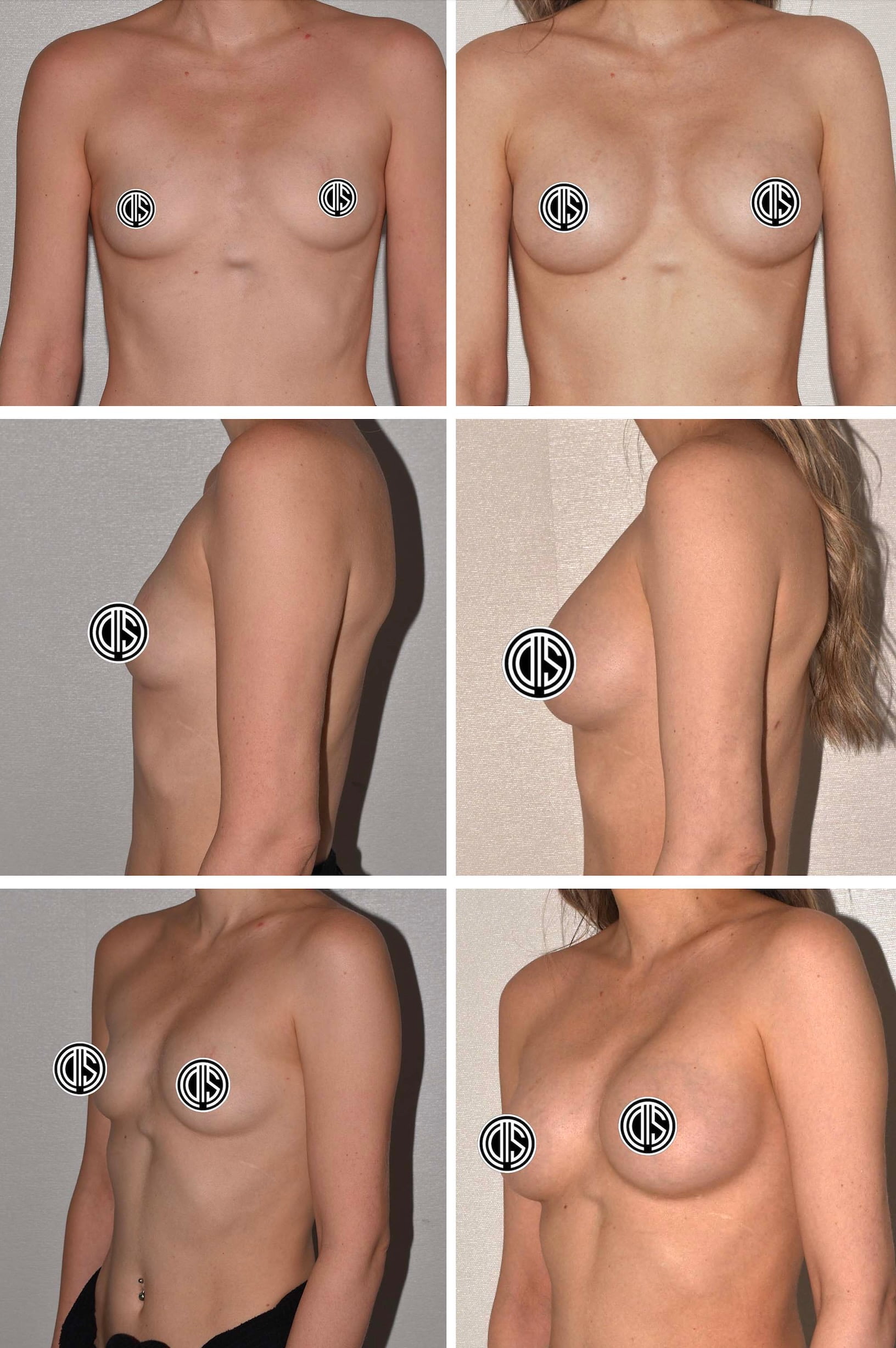 Six-panel image showing before-and-after views of a woman's torso from front and side angles following breast augmentation surgery; nipples are covered for modesty.