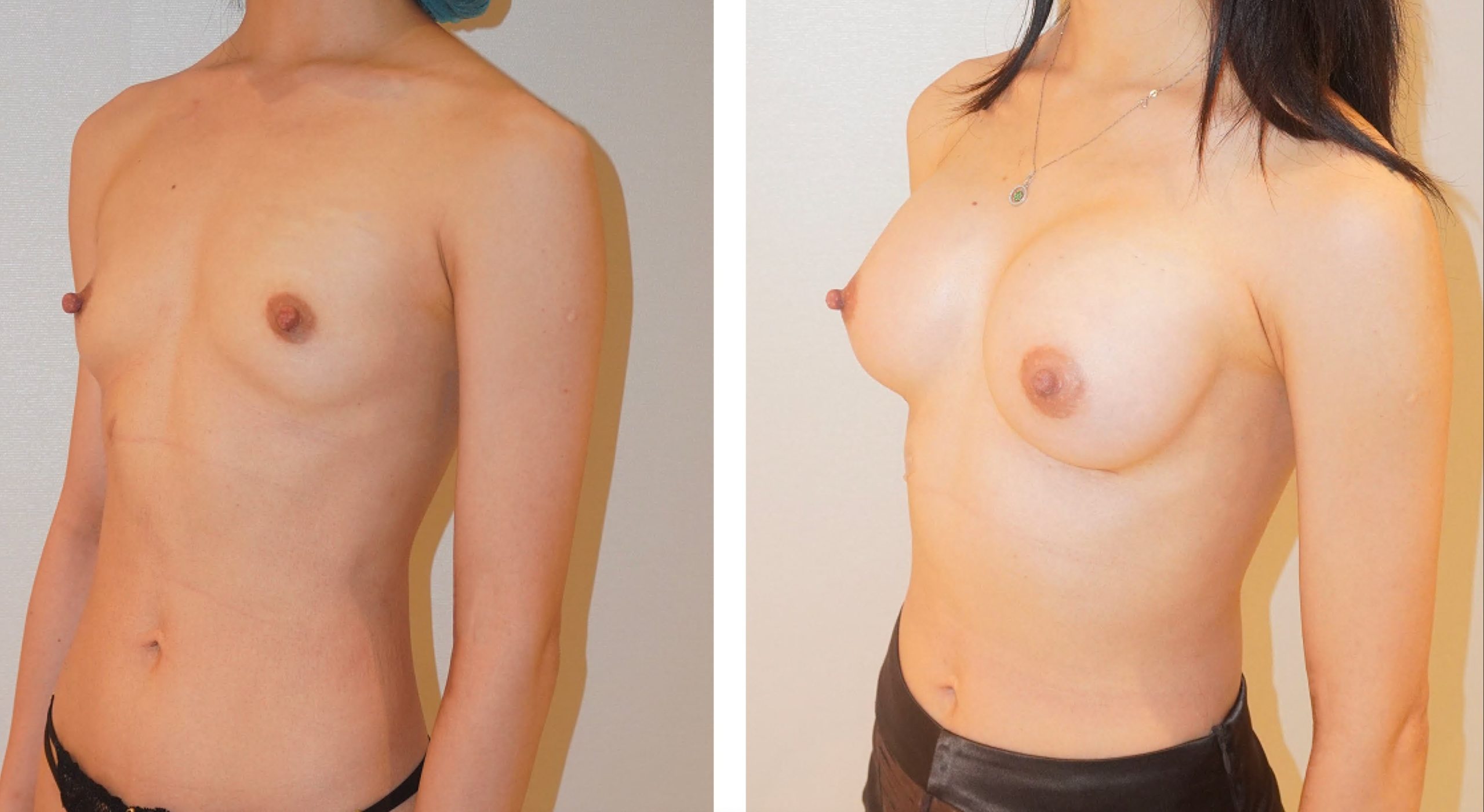 Side-by-side comparison of a person’s torso before (left) and after (right) breast augmentation surgery, showing an increase in breast size and shape.