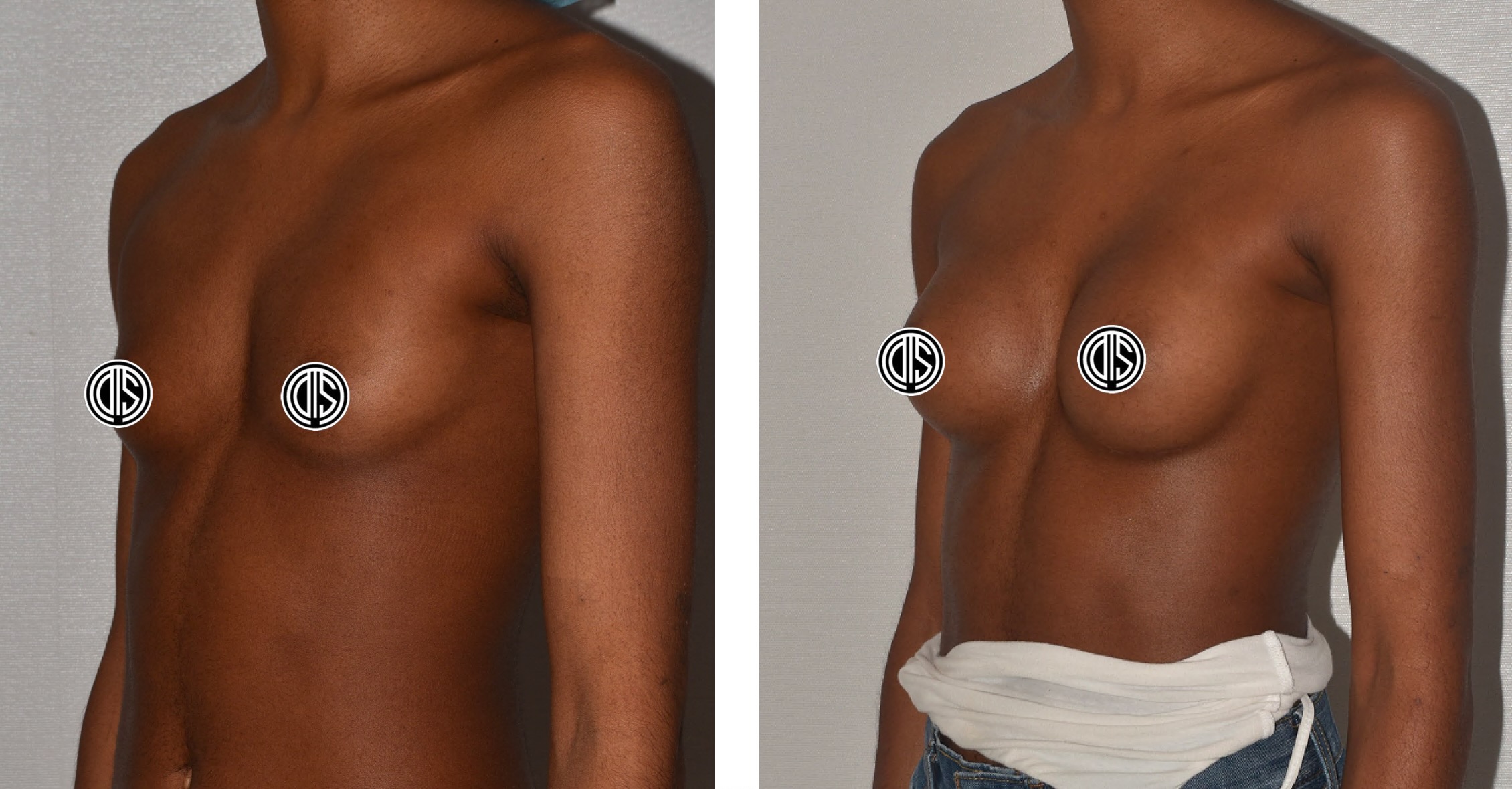 Side-by-side photos showing the torso of a person with a flat chest, viewed from the front and at an angle. The nipples are covered with circular symbols for modesty.