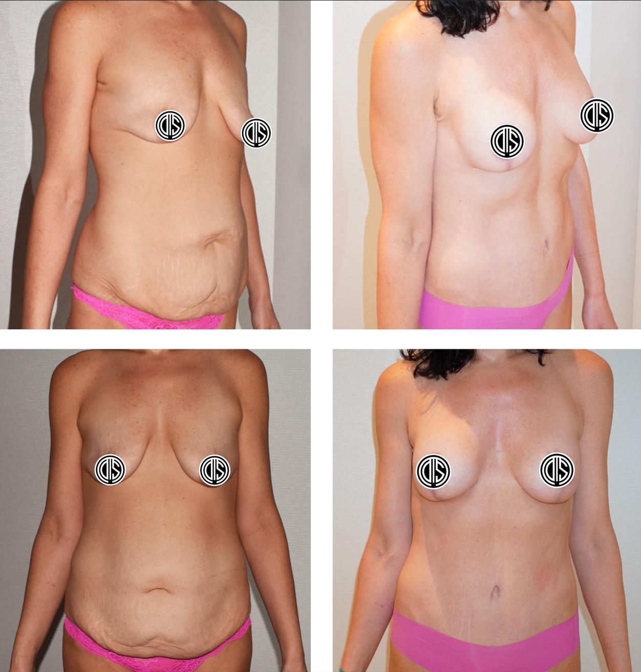 Before and after photos of a woman showing changes in her abdomen and breasts, likely following cosmetic surgery; before images on left and after images on right.