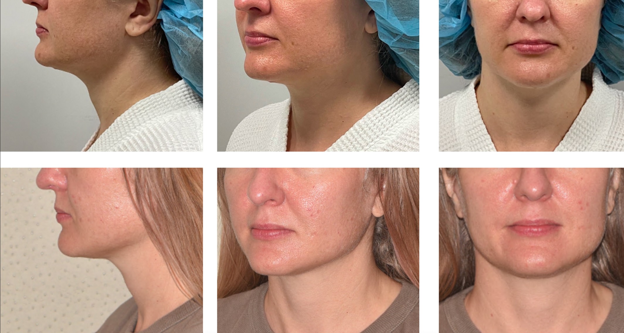 Six photos show a woman's lower face and neck from side and front angles, before (top row) and after (bottom row) a cosmetic procedure.
