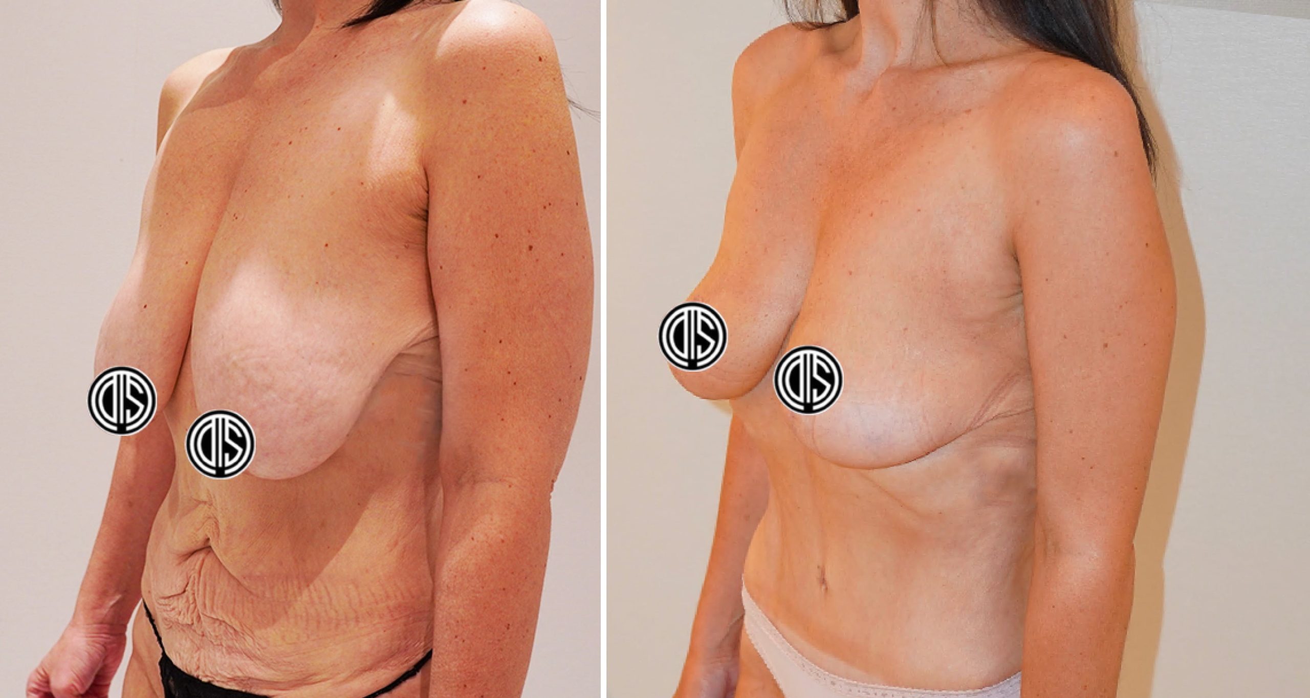 Side-by-side comparison of a woman showing her torso before and after breast and abdominal cosmetic surgery, with nipples censored in both images.