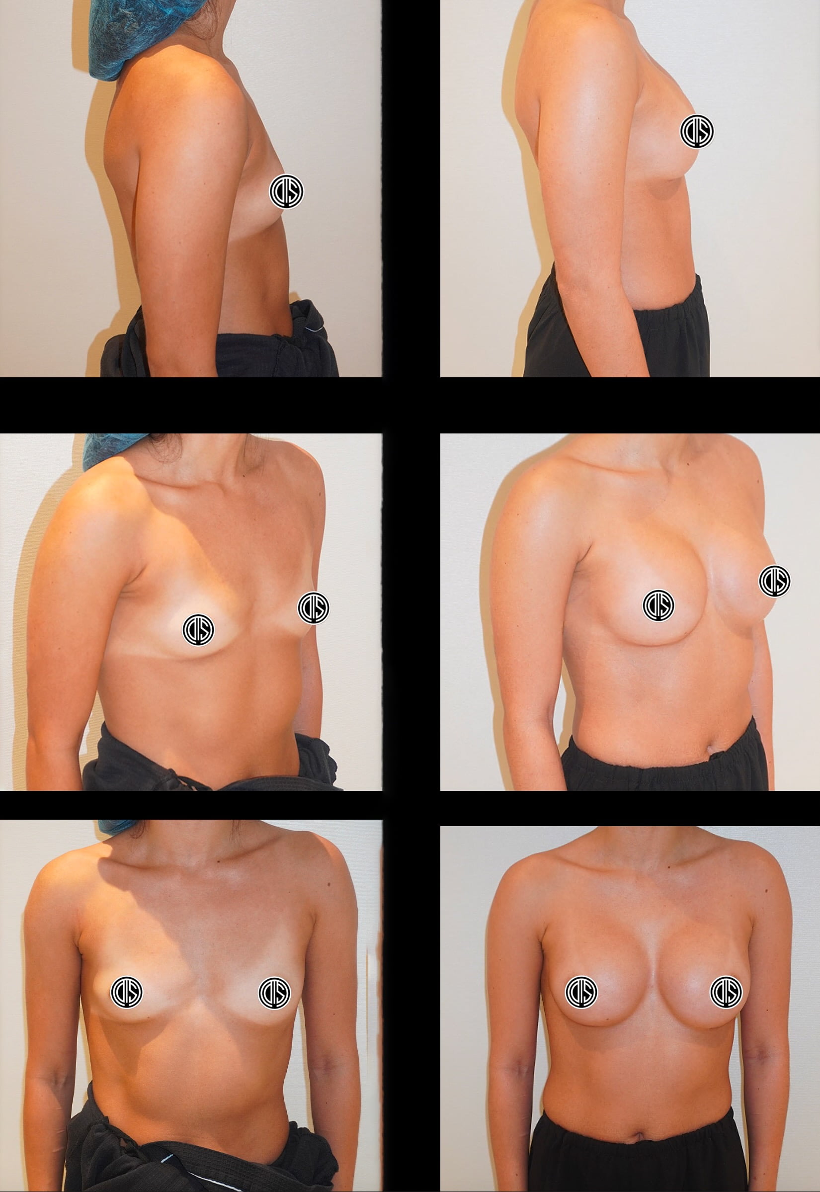 Three sets of before-and-after photos showing a woman’s torso and chest from different angles, highlighting changes in breast size and shape after augmentation surgery.
