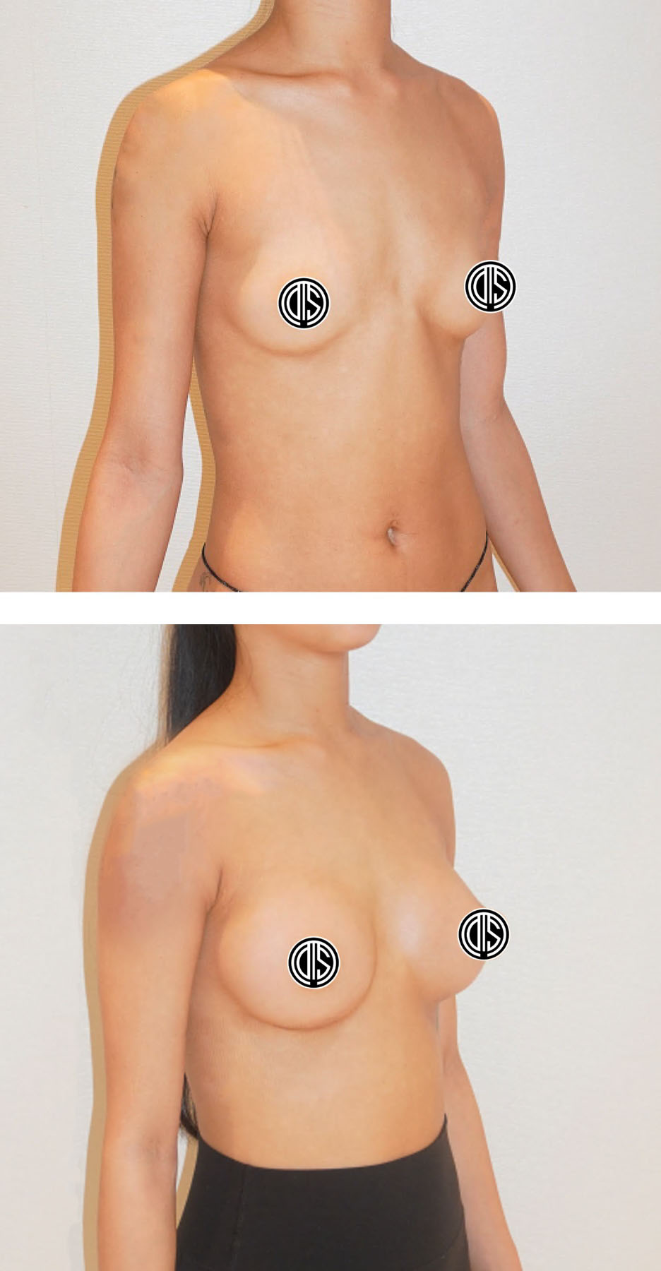 Two side-by-side photos show a woman’s torso before (top) and after (bottom) breast augmentation surgery. Circular symbols cover the nipples for modesty.