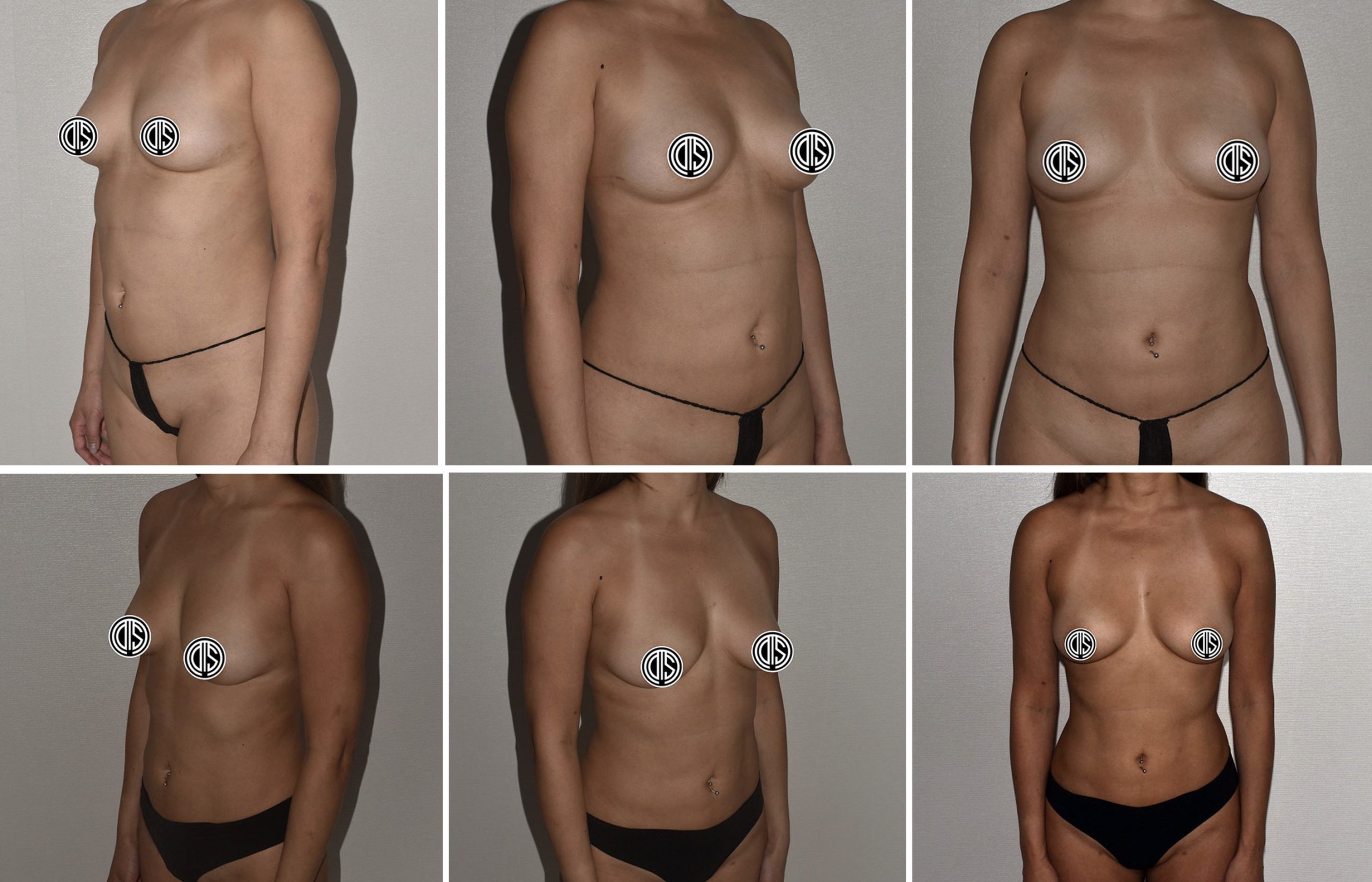 Six side-by-side images show a person from different angles before and after a breast augmentation procedure, with the nipples obscured for privacy.