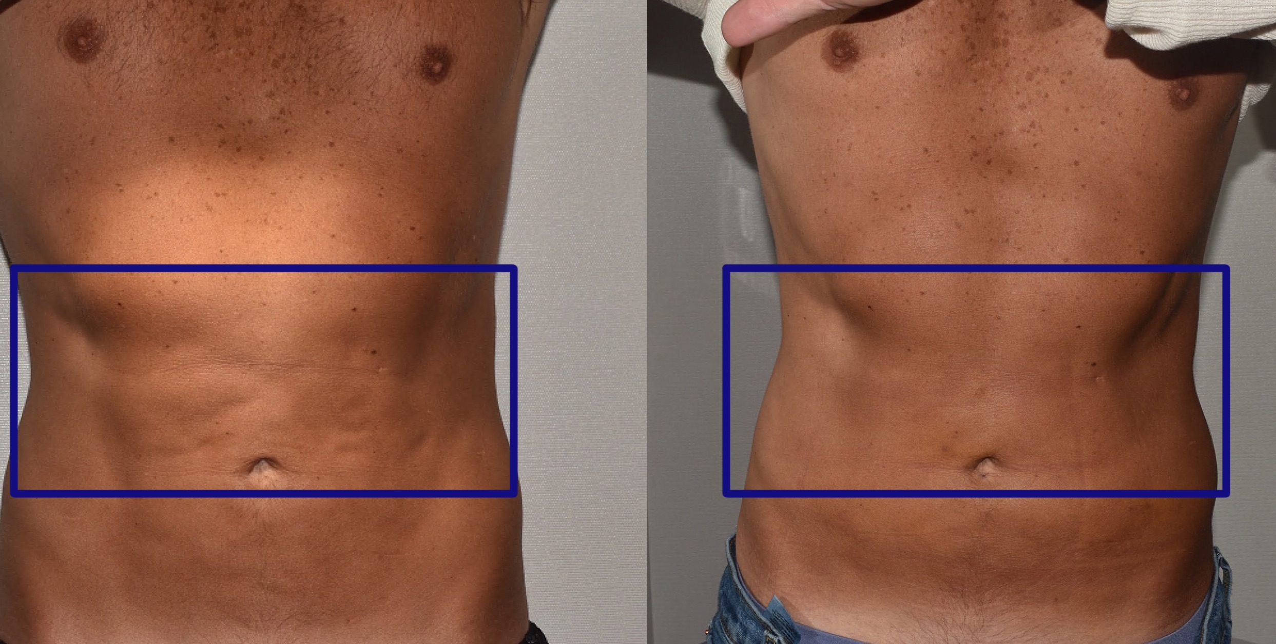 Side-by-side comparison of a person's abdomen before and after liposuction revision, with a blue rectangle highlighting the midsection in both images.