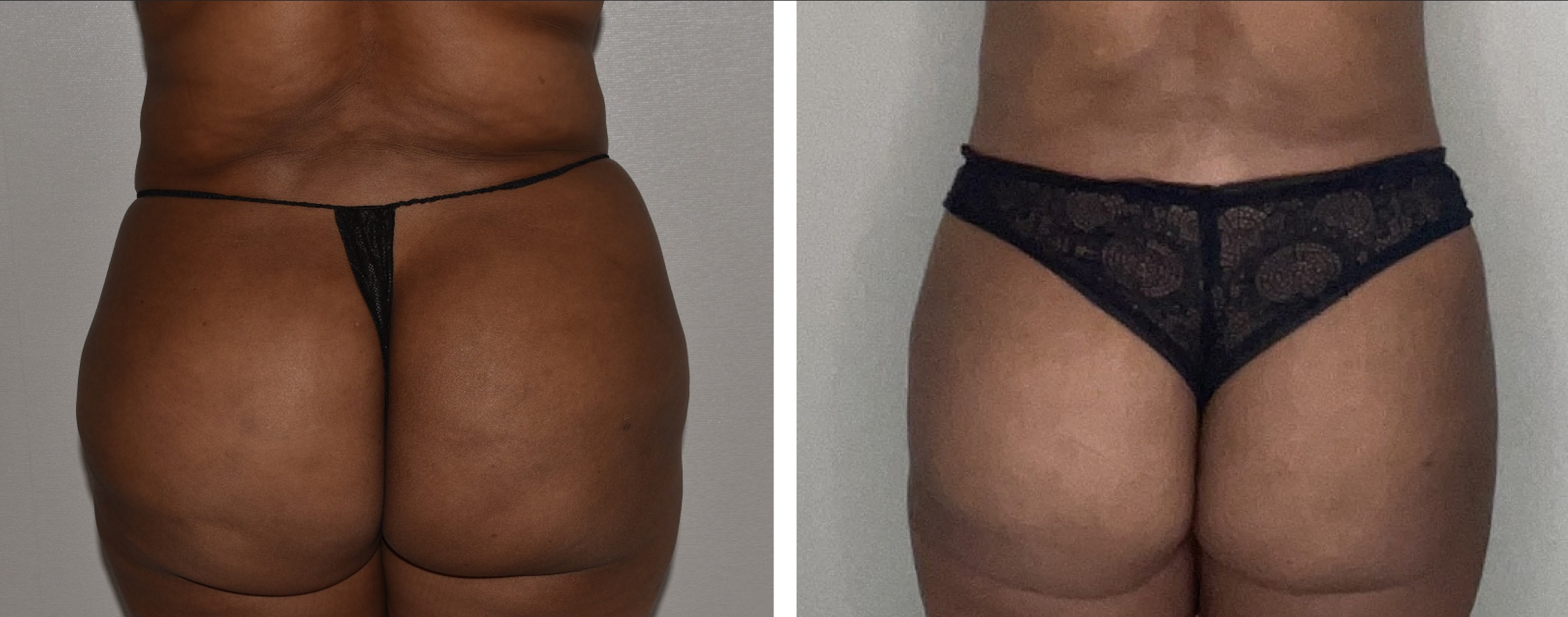 Side-by-side before and after images show the back view of a person in underwear, highlighting changes in skin texture and body contour following liposuction revision.
