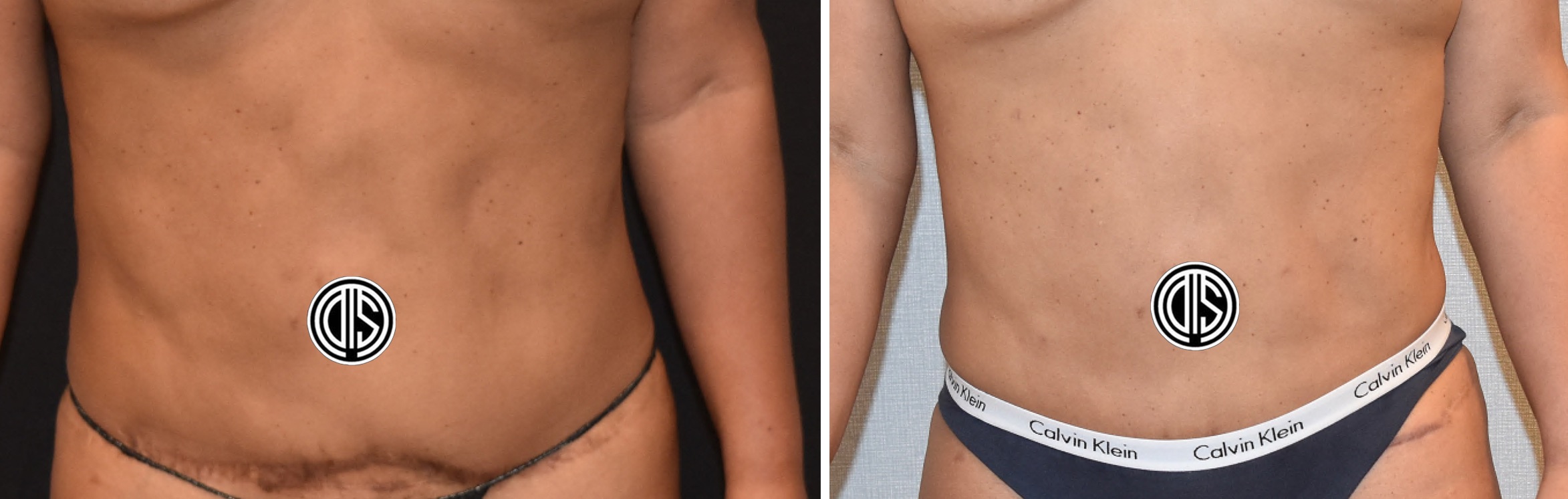 Side-by-side before and after images of a person's lower torso, showcasing the results of a liposuction revision with a noticeably slimmer waistline and reduced lower abdominal bulge.