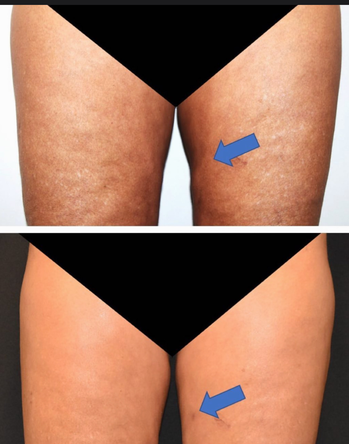 Two side-by-side photos show liposuction results on the front of upper thighs before and after treatment, with blue arrows indicating the same area; skin texture appears smoother in the after image.