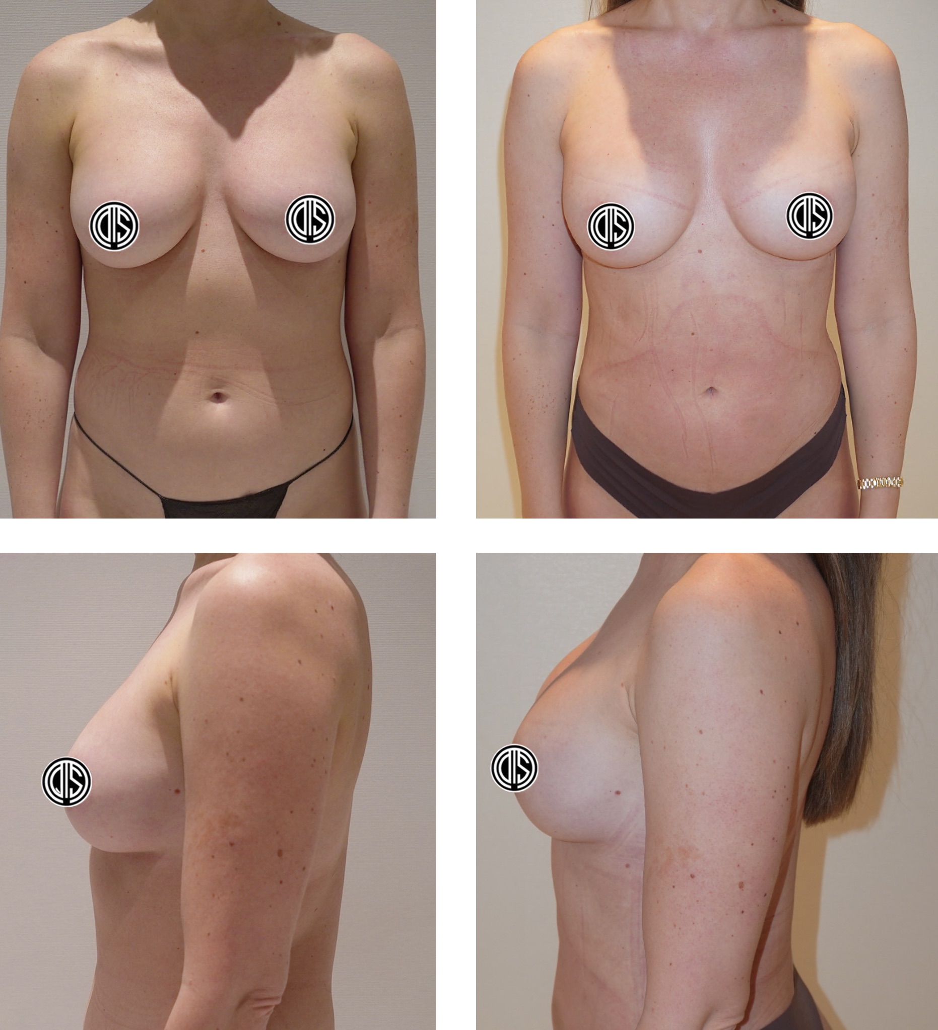 Four-panel image showing before-and-after views of a woman’s torso from the front and side, illustrating breast shape and size changes after Breast Fat Transfer. Sensitive areas are censored.