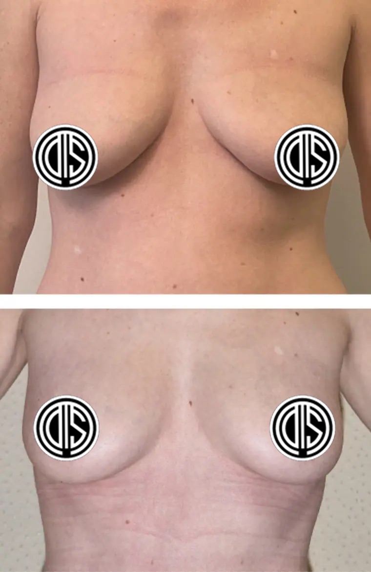 Two side-by-side before and after images of a topless person’s chest, with nipples censored, illustrate changes in breast shape and positioning following Breast Fat Transfer.
