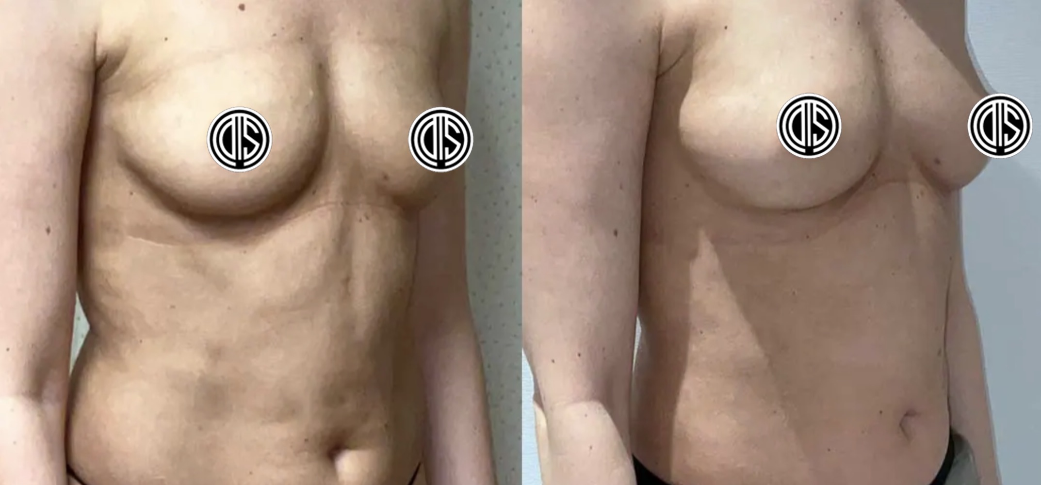 Two side-by-side before and after images show a woman's torso before and after a breast fat transfer procedure, with the nipples censored for privacy.