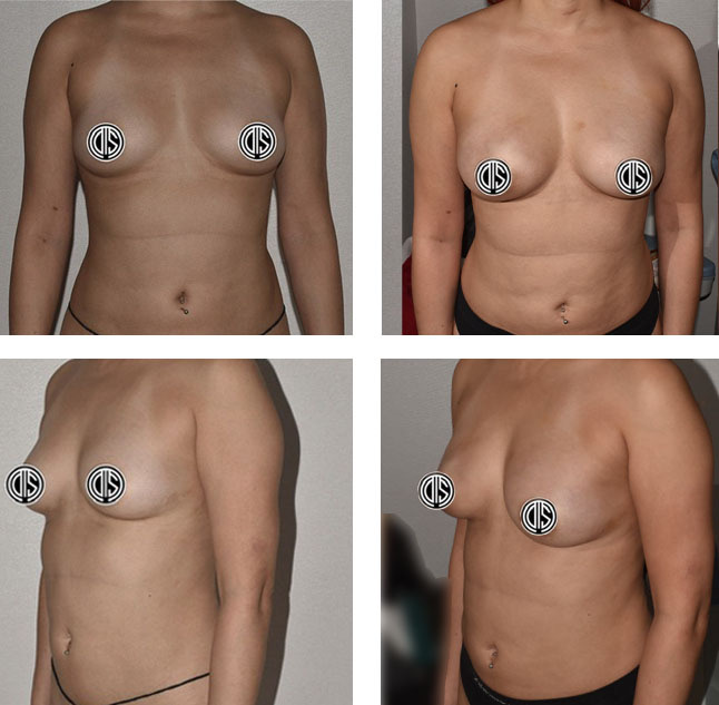 Four images display a woman’s torso from different angles before a Breast Fat Transfer procedure, with her nipples censored for privacy.