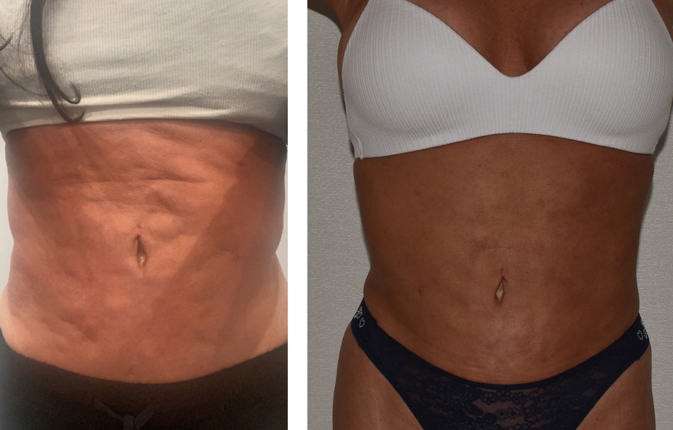 Two side-by-side before and after images display a woman's torso transformation; the left shows loose skin, while the right reveals firmer, more toned liposuction results.